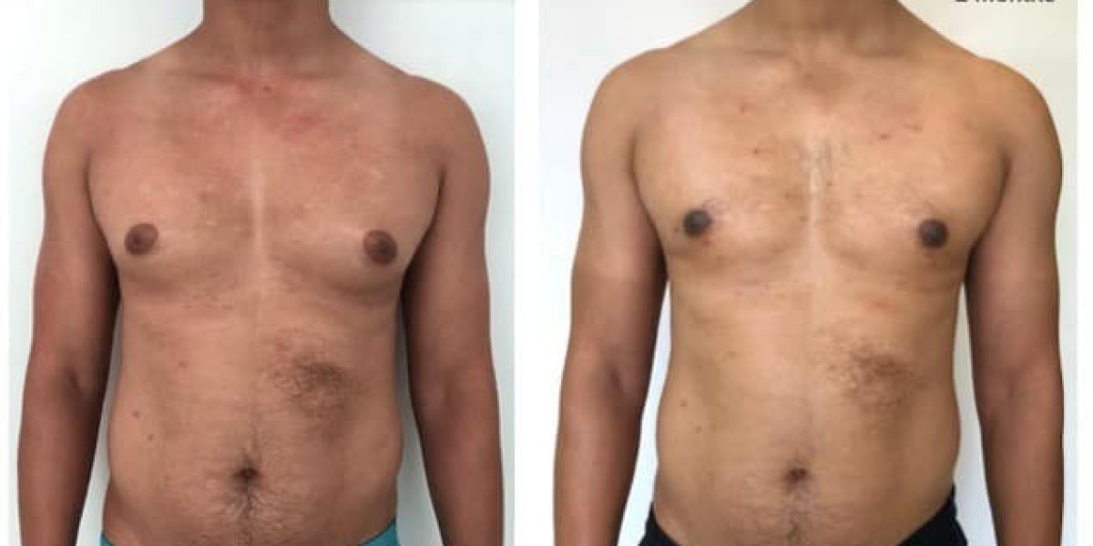 Gynecomastia Surgery in Bangalore