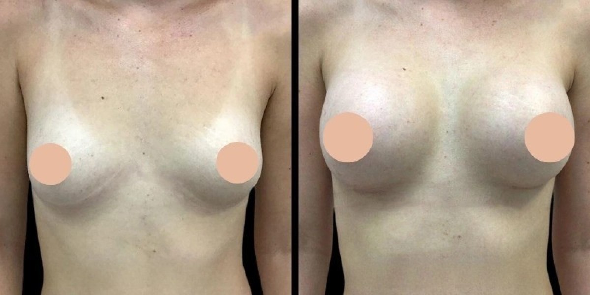 Breast Augmentation Consultation by the Best Doctors in Dubai