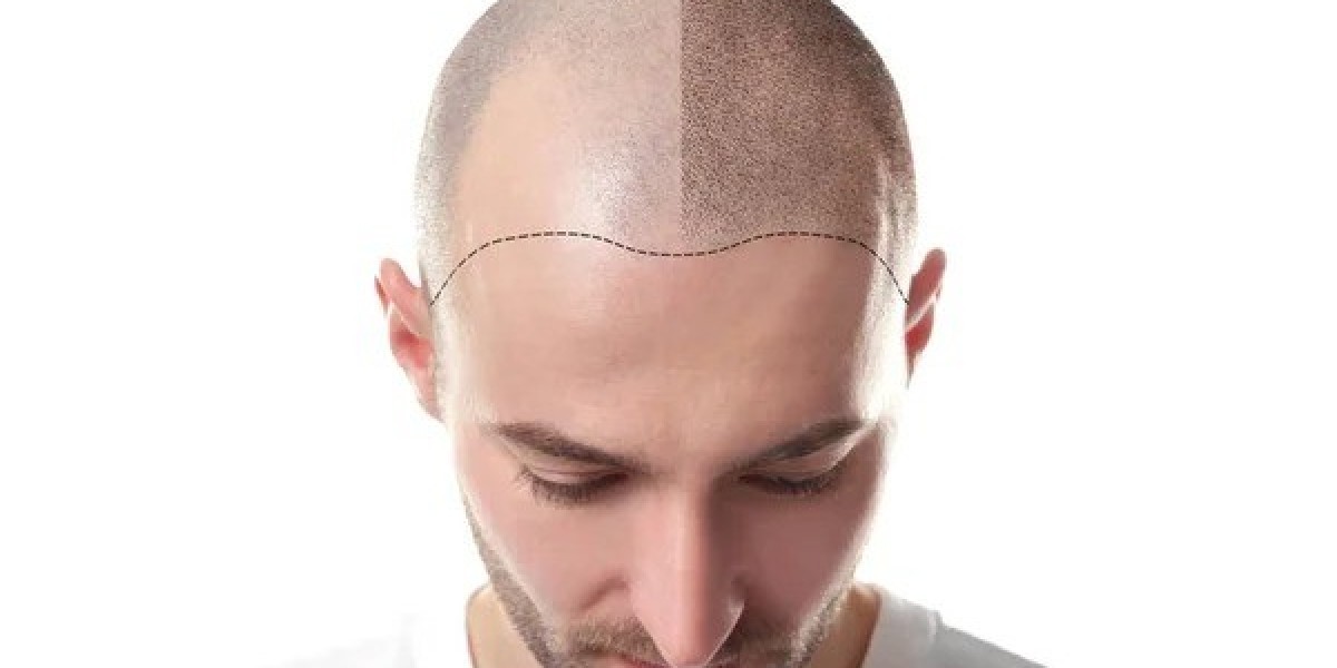 Is Hair Transplant Safe for Sensitive Skin?