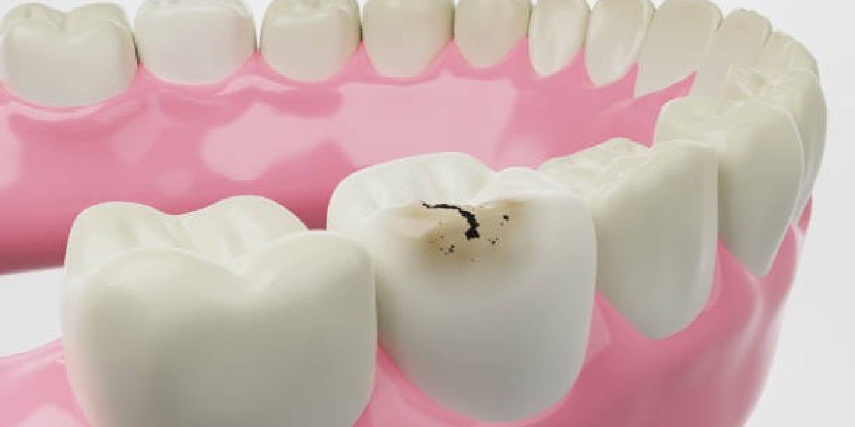 A Simple Solution for Long-Term Tooth Protection Dental Fillings in Islamabad: