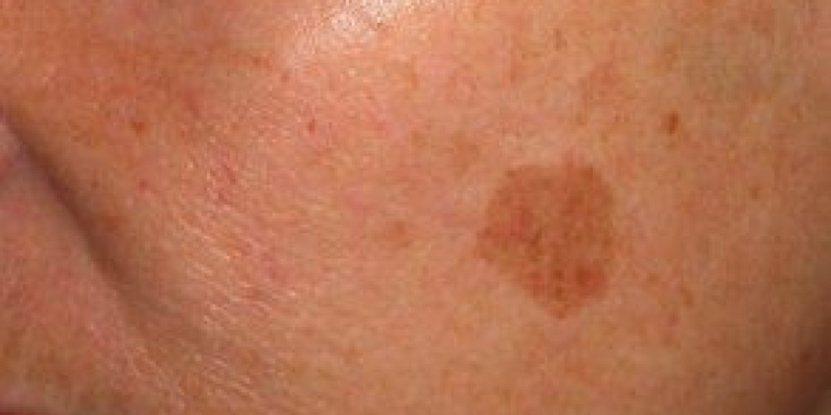 Birthmark Removal in Dubai: Personalized Treatment Plans Explained