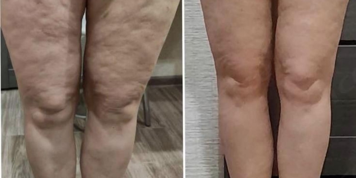 Flatten the Chest: Fat Melting Injection in Dubai for Men