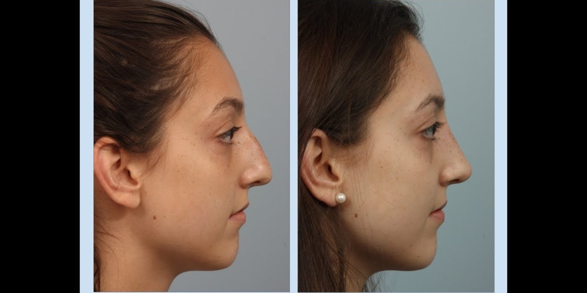Can rhinoplasty correct a flat nasal bridge in Dubai?