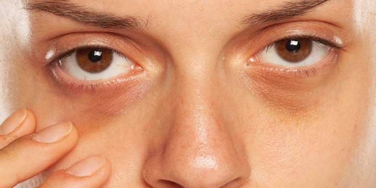 Dark Circle Treatment in Riyadh Reduce Dark Shadows Safely
