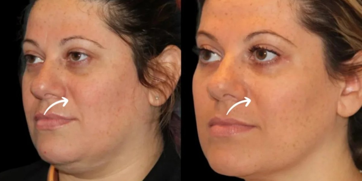 Sculptra as a Lifestyle Investment by Best Doctors in Dubai