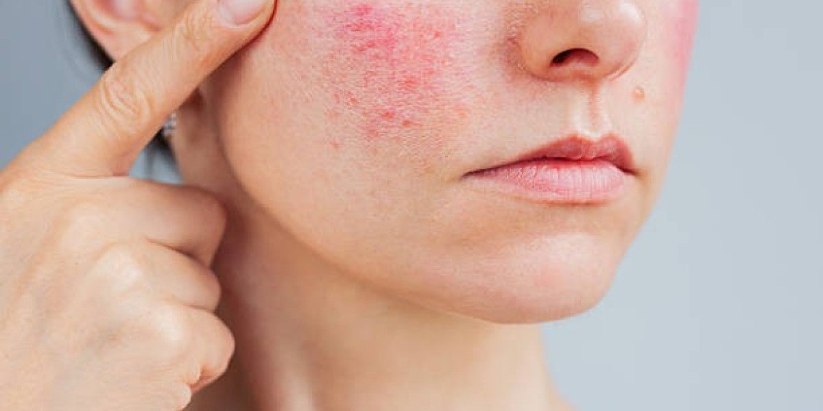 Who Benefits Most from Laser Acne Treatment? Personalized Skin Revival Guide