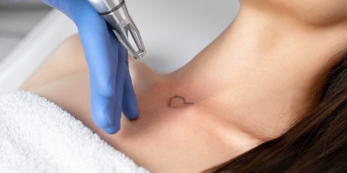 Tattoo removal in Dubai: Is it really painful?
