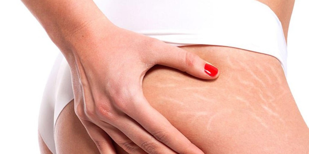Can Stretch Marks on Thighs and Hips Be Treated Successfully?