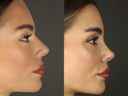 Nose Job Surgery (Rhinoplasty ...