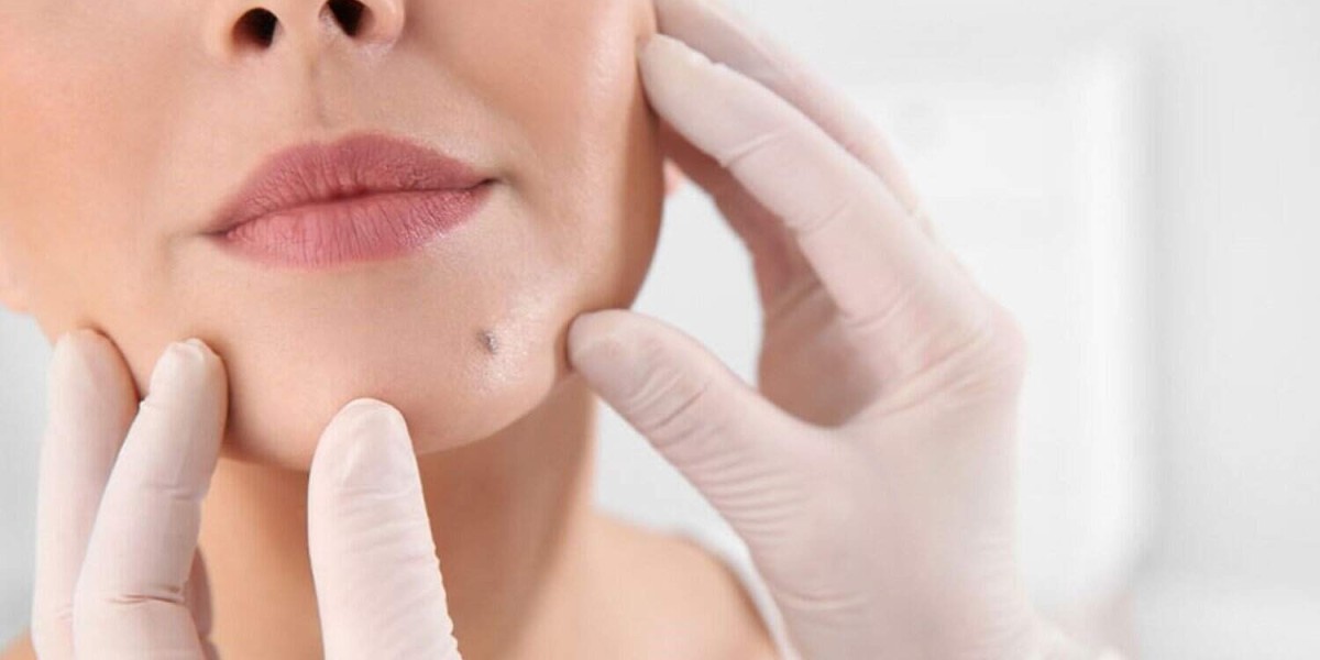 Laser Mole Removal in Islamabad: Before, During and After Treatment