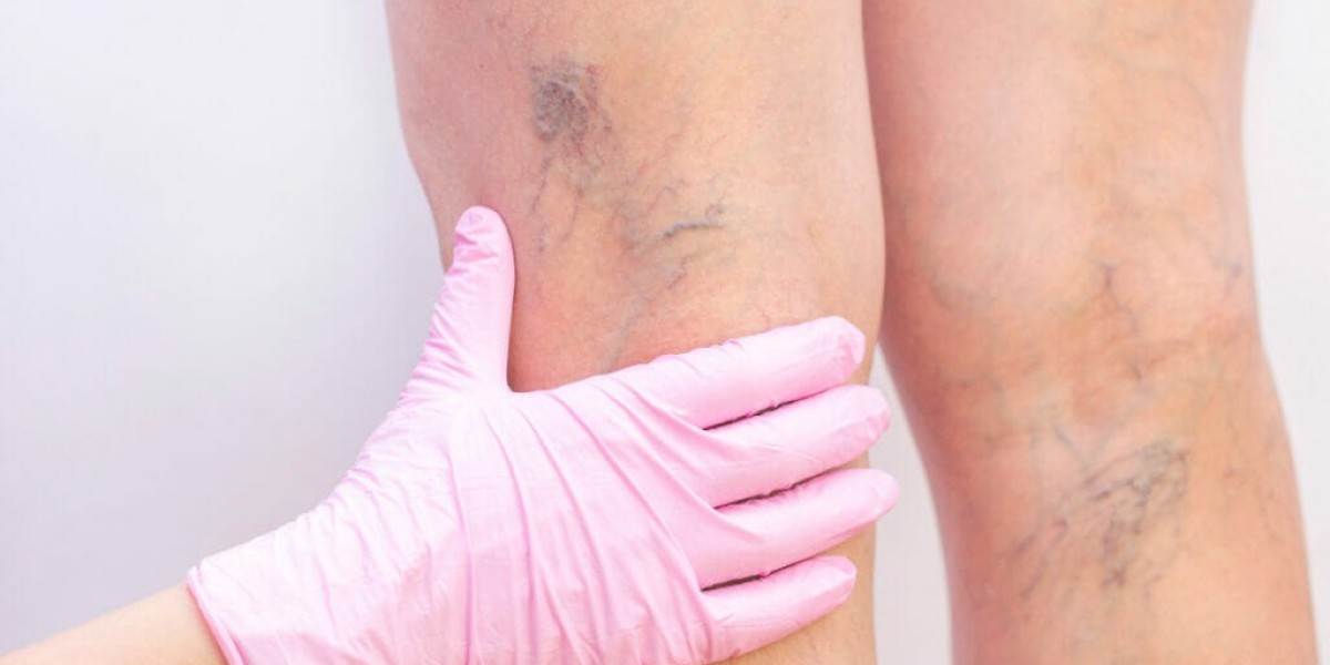 Is Varicose Vein Treatment Suitable for Older Adults?