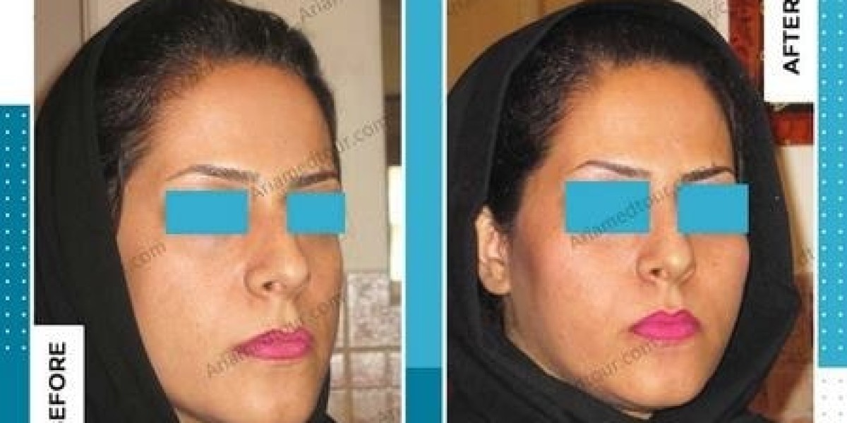 Enhancing Facial Symmetry: The Benefits of Cheek Augmentation in Riyadh