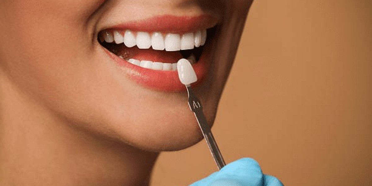 Does Composite Veneers Change Tooth Shape?