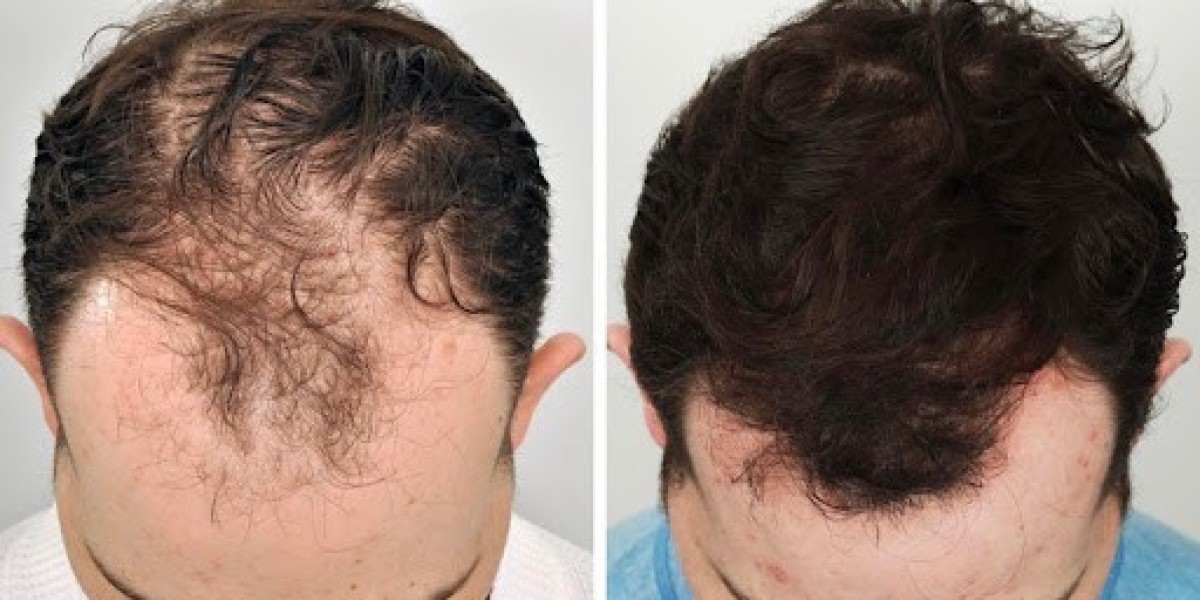 The Cost of Confidence: Hair Transplant in Riyadh Price Guide
