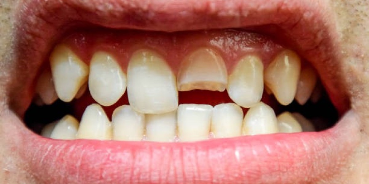 Advanced Tooth Fracture Treatment in Islamabad: Restore Your Smile