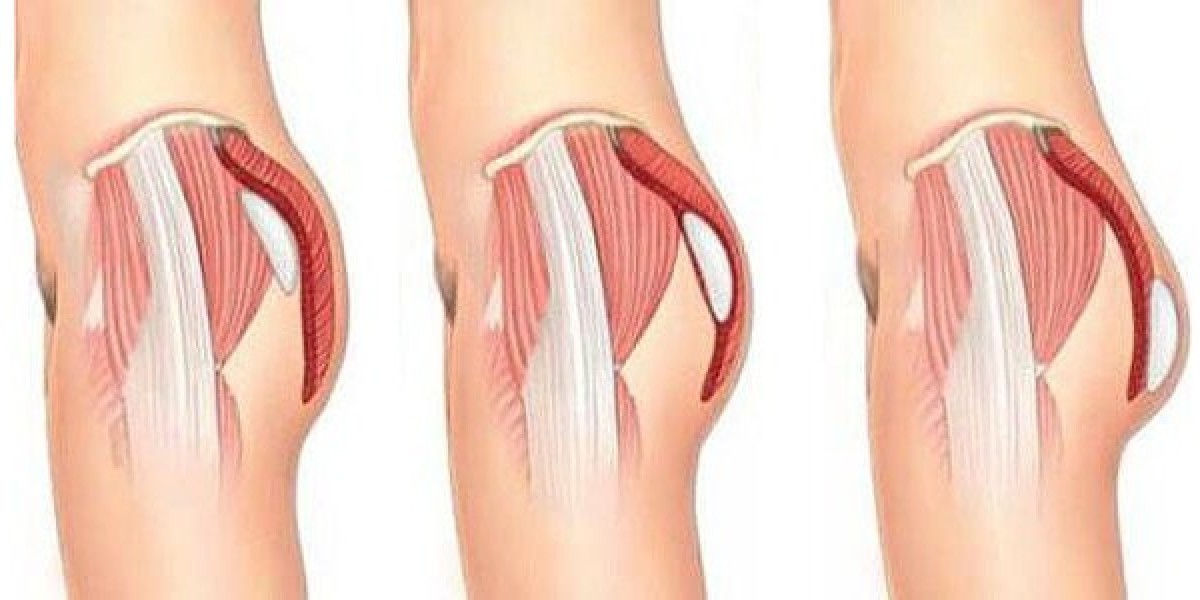 Understanding the Benefits of French Butt Reshaping for Riyadh Residents