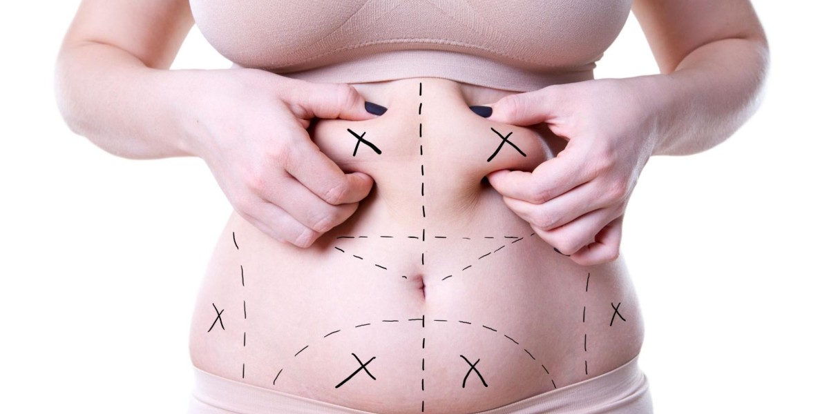 Exercise After Liposuction in Islamabad: Safe Guidelines