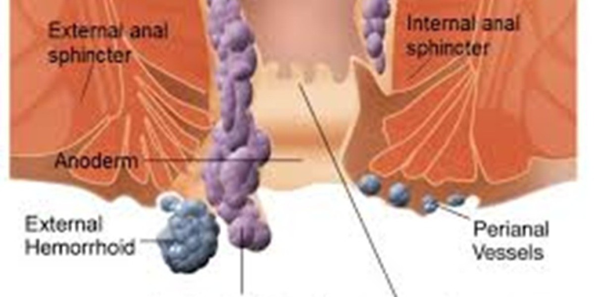 How Hemorrhoid Embolization Can Reduce Pain and Discomfort