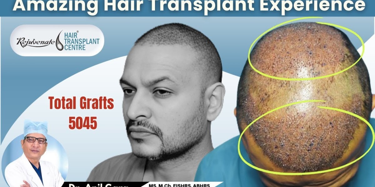 Hair Transplants for Men: Targeting Male Pattern Baldness in Dammam