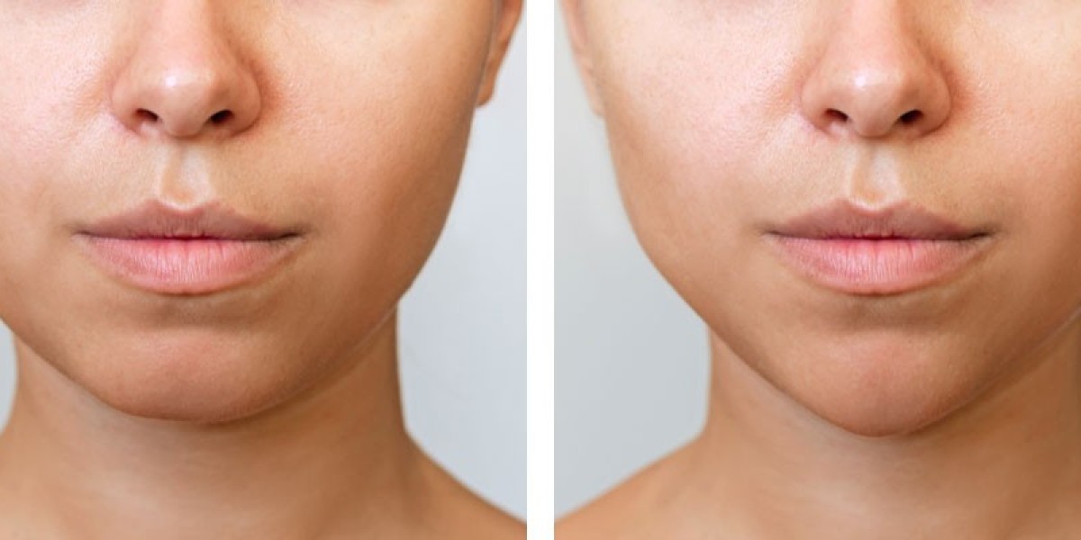 What to Ask During Your Chin Reduction Consultation in Riyadh