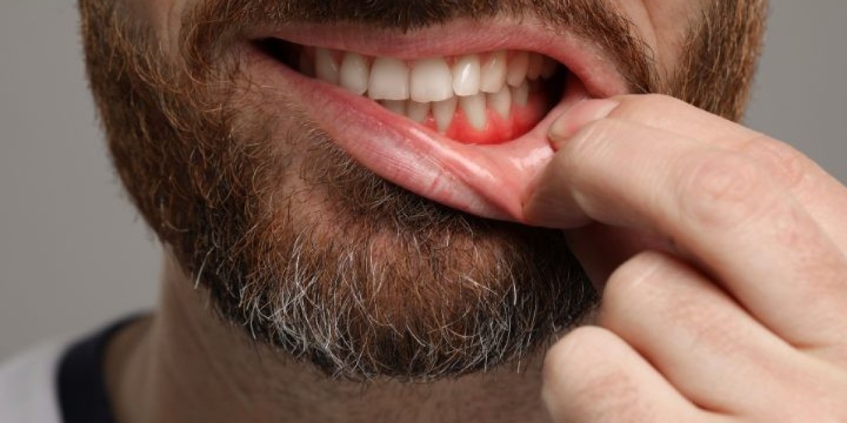 How to Stop Bleeding Gums Naturally and Effectively