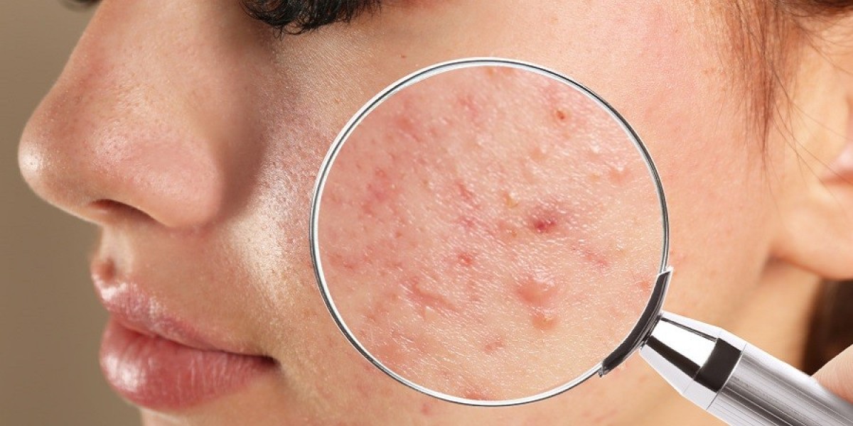 Preparing Your Skin for Acne Treatment in Riyadh