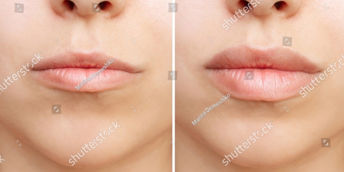 Understanding the Safety and Efficacy of Modern Lip Fillers