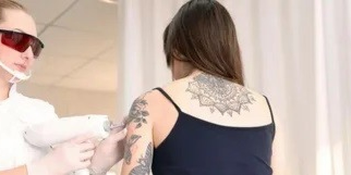 Professional vs Home Tattoo Removal in Islamabad