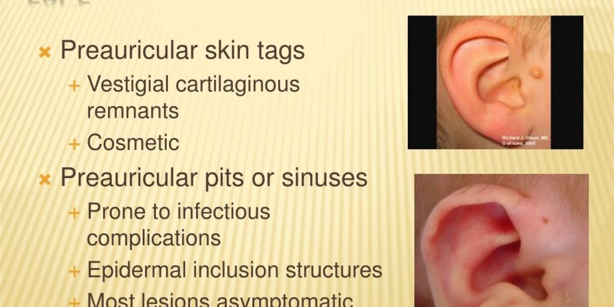 A Guide to Safe Preauricular Tag Removal in Riyadh