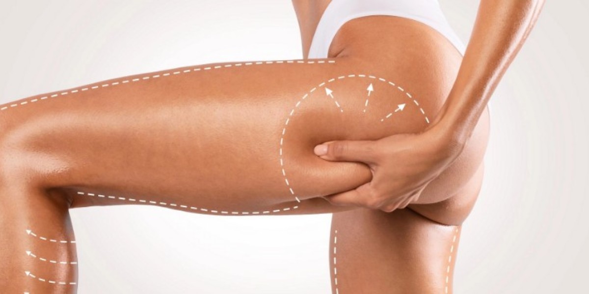 Everything You Need to Know About BBL Surgery in Riyadh