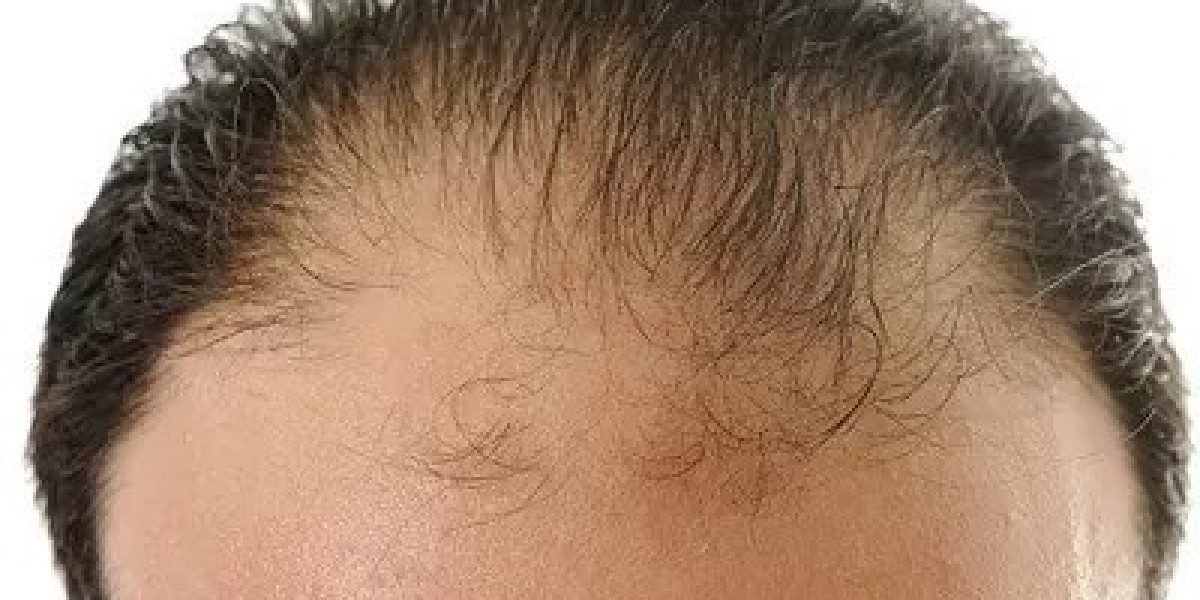 Hair Transplant and Hair Growth Cycle What’s the Connection?
