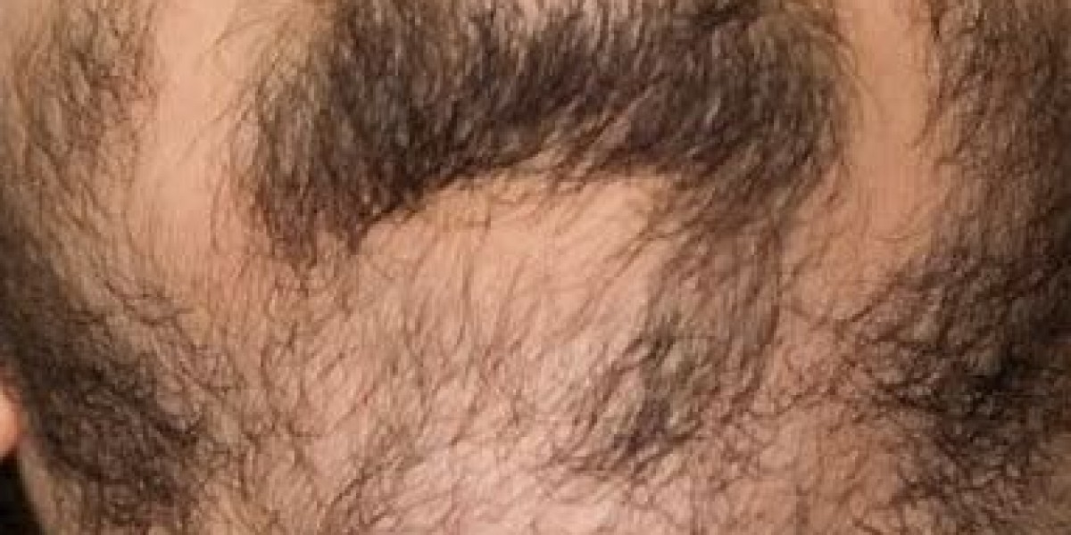 Can a Beard Hair Transplant Help With Genetic Hair Loss?