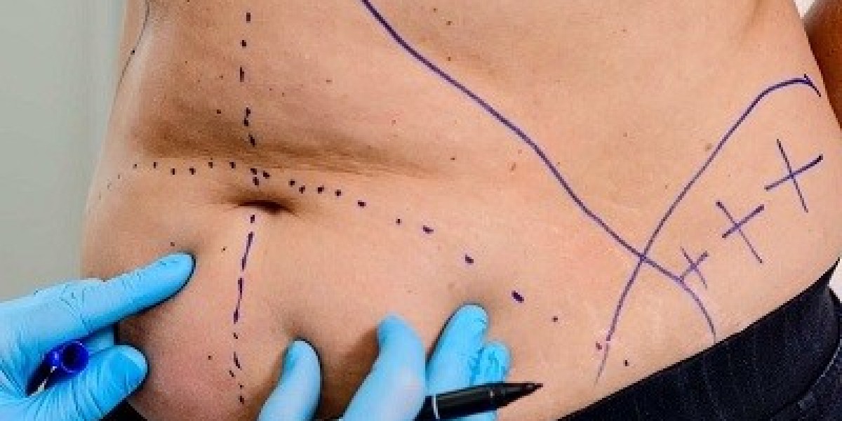 Discover the Power of Liposuction in Riyadh