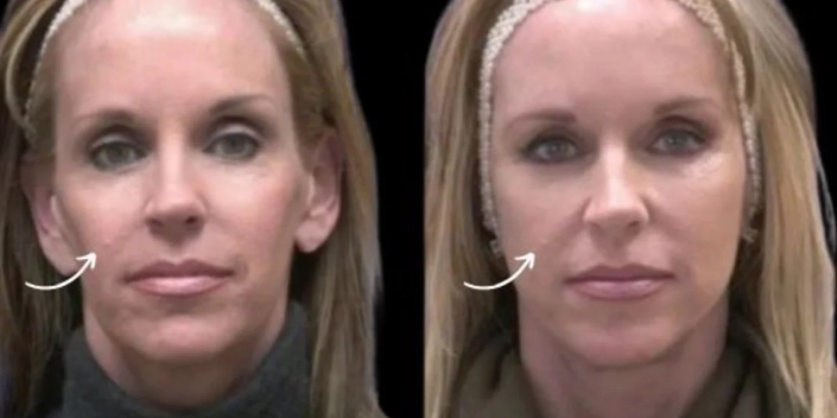 Sculptra Fillers Organic Skin Glow by Best Doctors Dubai