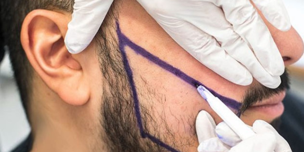 Permanent Beard Density: What to Expect in Riyadh