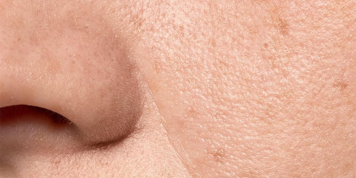 When to Expect Savings on Large Pores Treatment Cost in Dubai