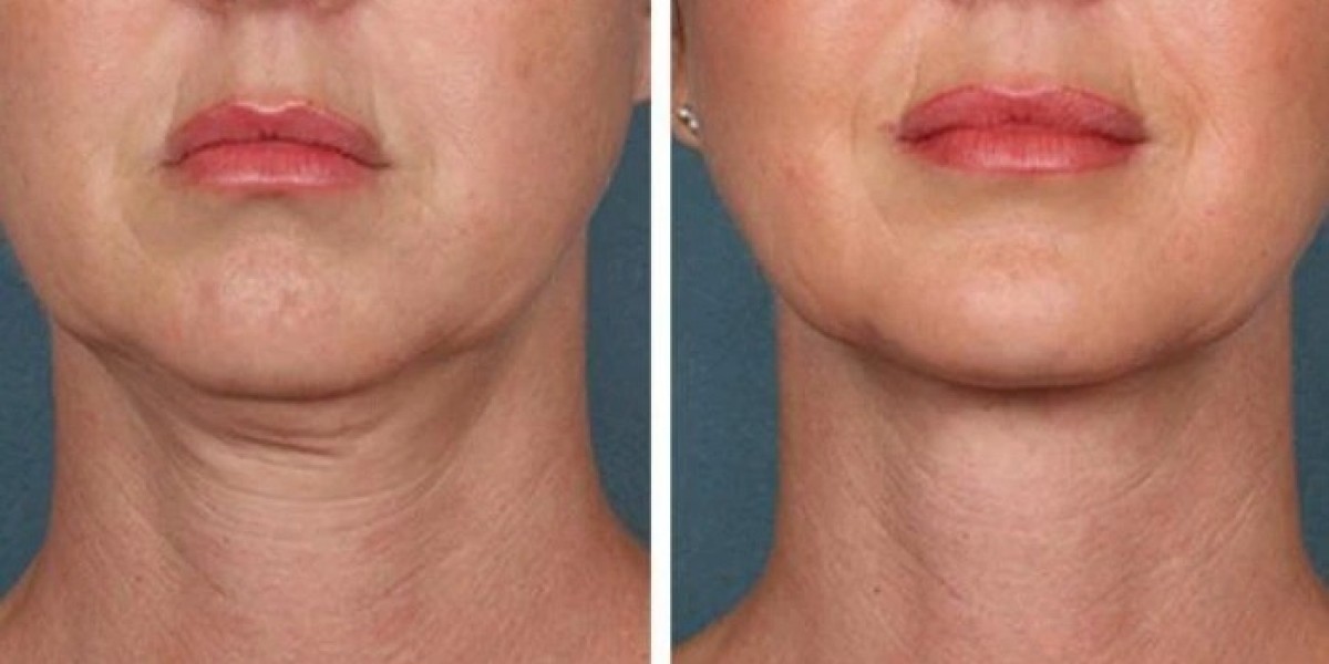 Best Aesthetic Clinics in Dubai Providing Premium PRP Injections Care