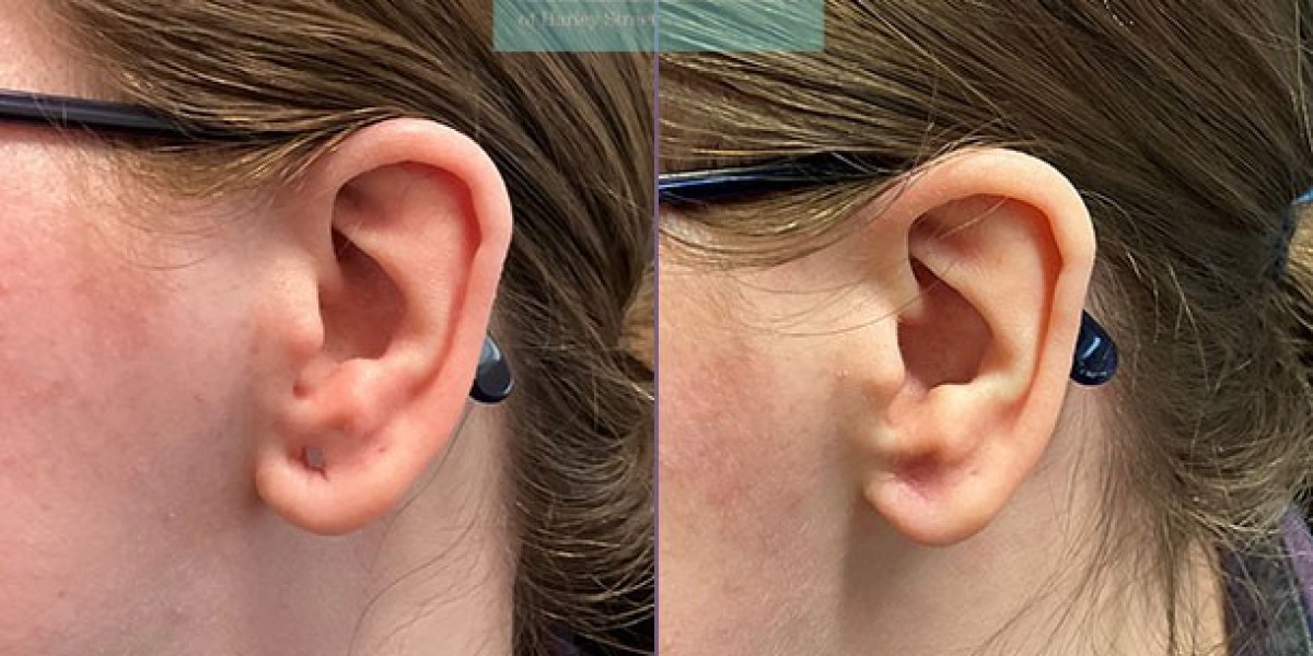 Earlobe Revision Surgery: Correcting Previous Surgical Results