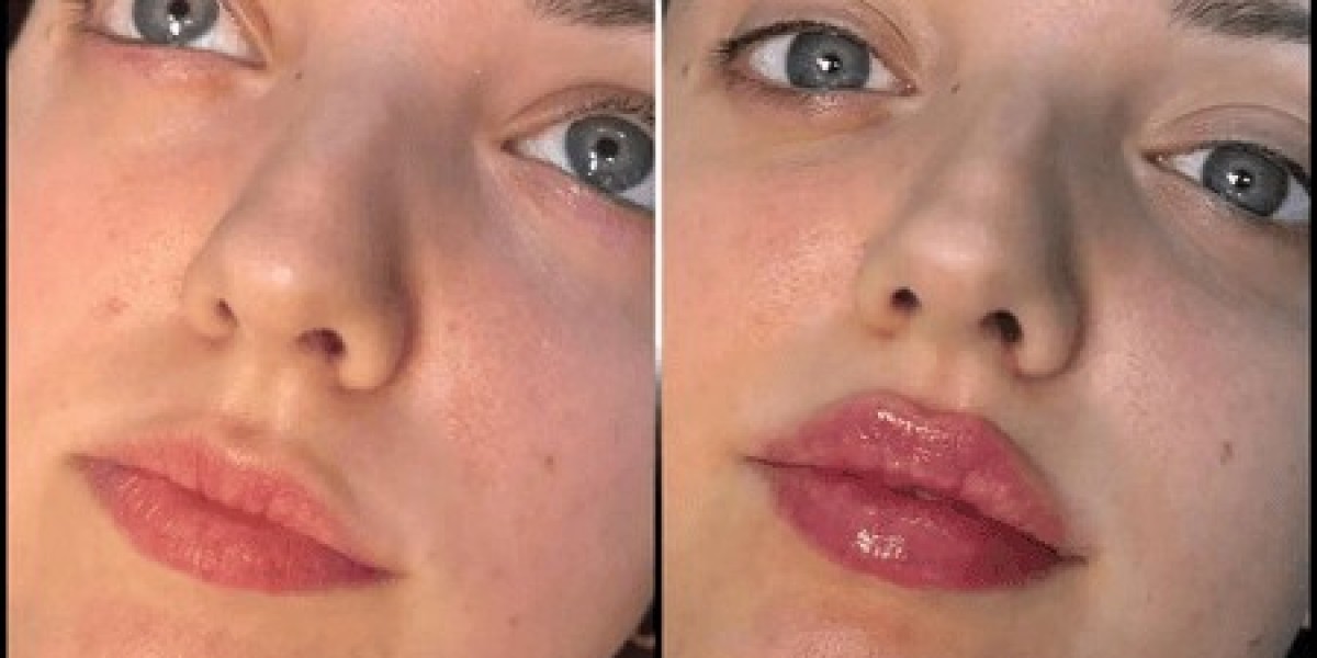 Best Plastic Surgeons in Dubai for Fillers: Achieving Natural Beauty