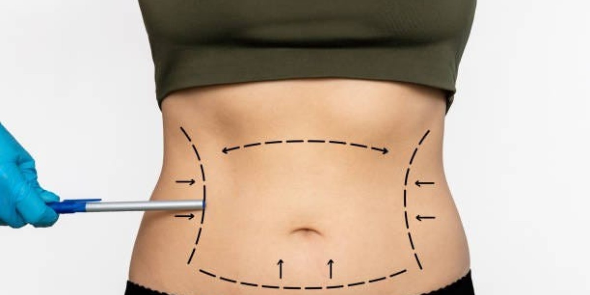 Are You a Candidate for Fat Transfer Surgery in Riyadh? Key Requirements