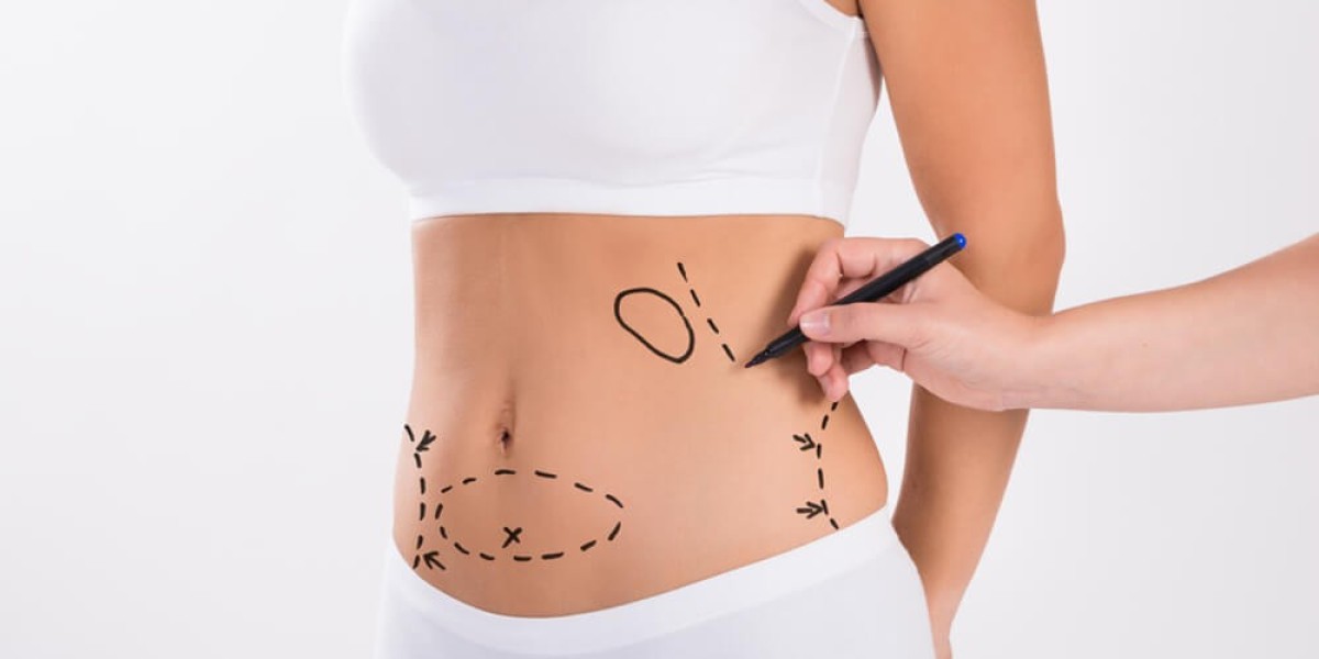 Refine Your Shape with Best Liposuction Surgeon in Dubai