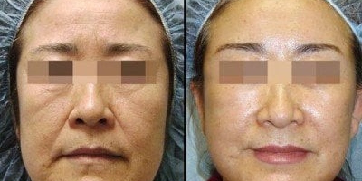 Stem Cell Facelift in Riyadh: Achieving a Youthful Glow Naturally
