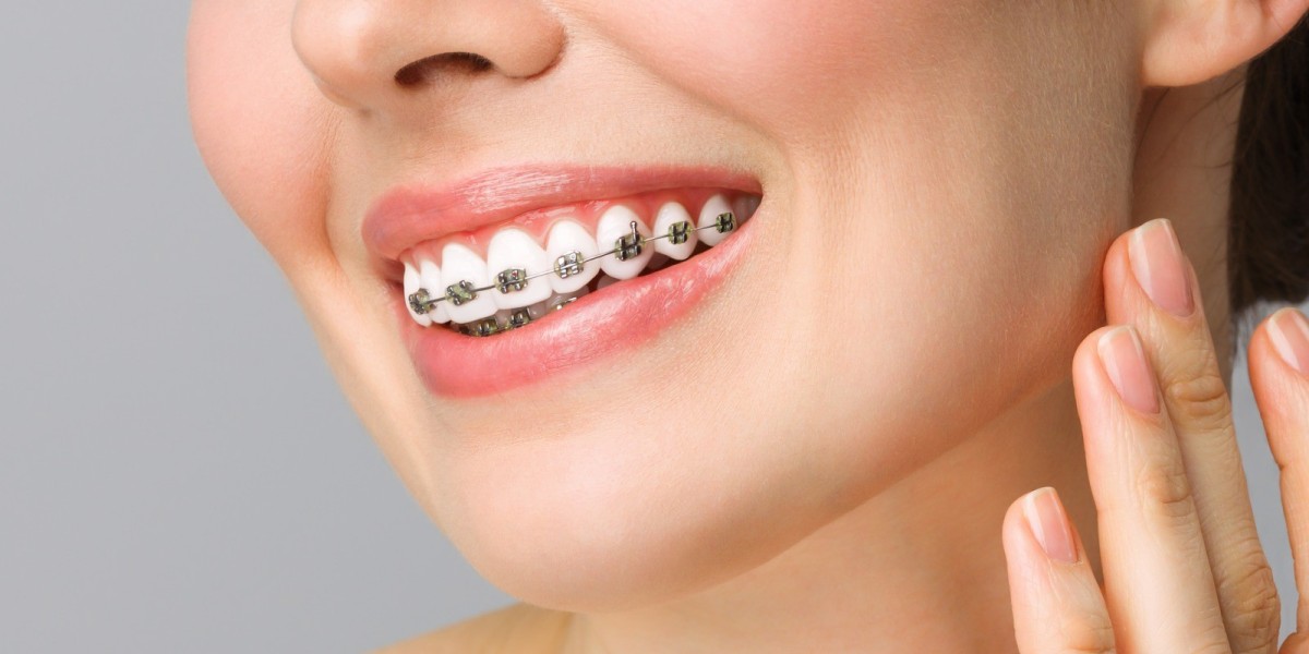 Quick Braces in Dubai: Fast and Effective Orthodontic Solutions