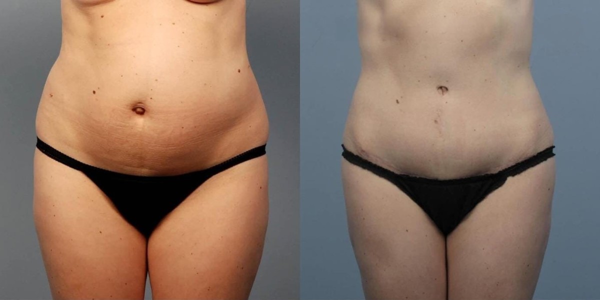 Achieving Sculpted Contours and Firmer Skin with BodyTite