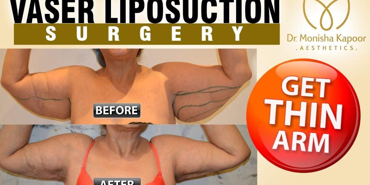 How Vaser 4D Liposuction in Riyadh Differs from Traditional Liposuction