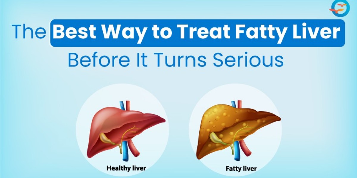 The Best Way to Treat Fatty Liver Before It Turns Serious