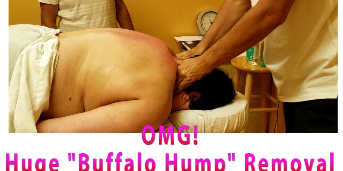 Enhancing Your Comfort and Confidence with Buffalo Hump Removal in Riyadh
