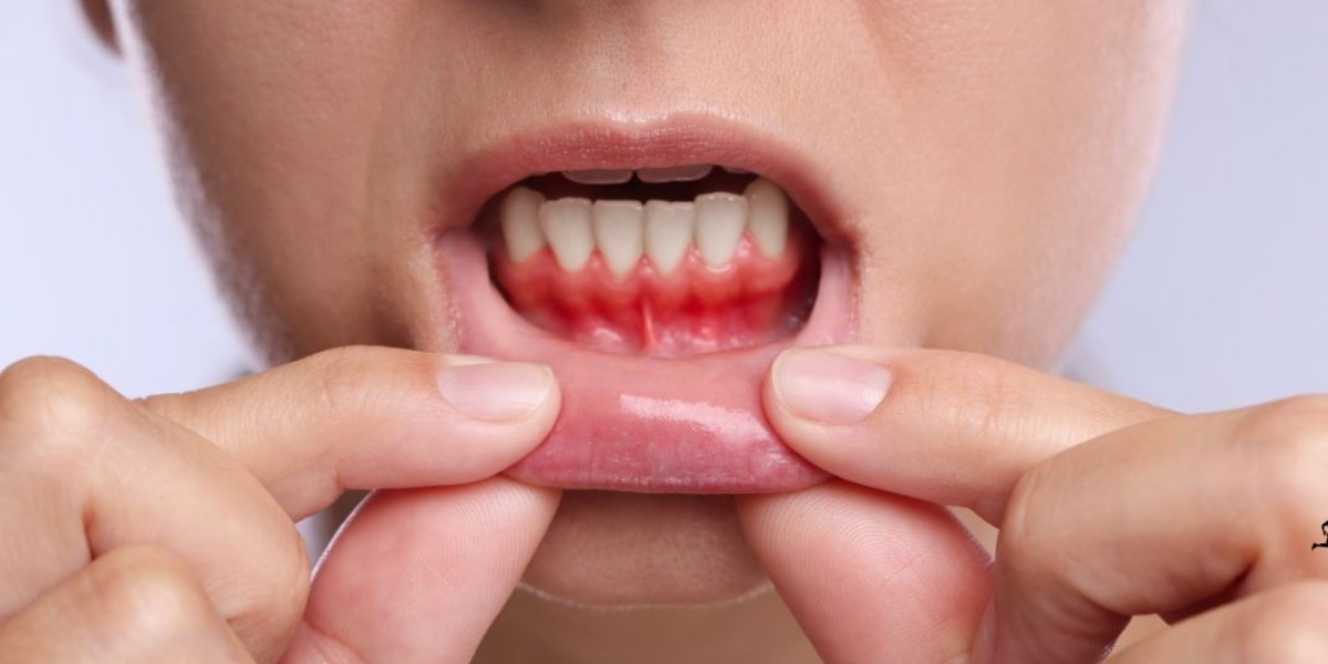 Managing Bleeding Gums: Why You Need a Scale and Polish in London