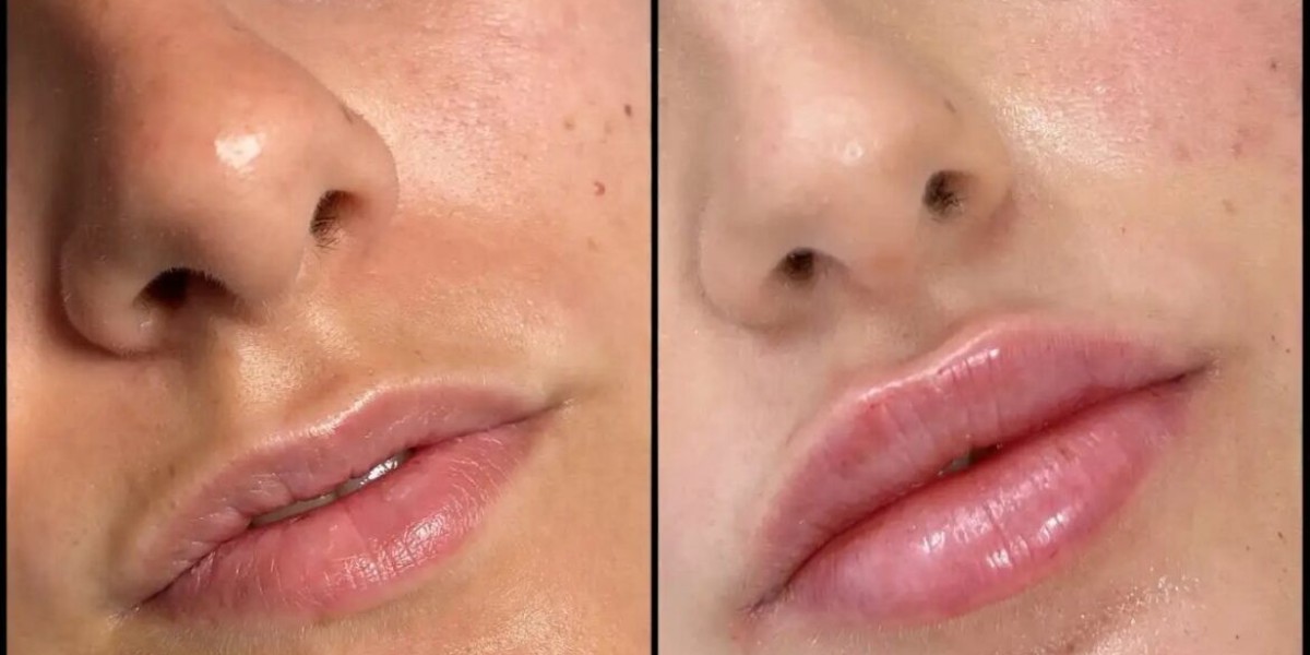 Flawless Definition: Best Plastic Surgeon in Dubai for Fillers