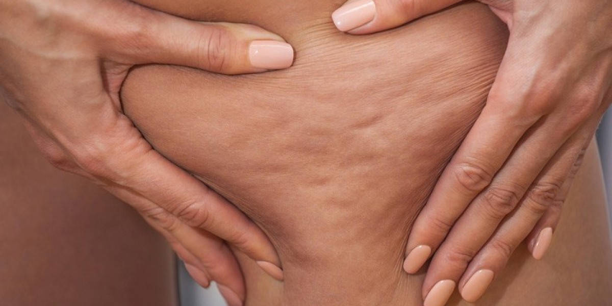 Cellulite Treatment Market: Driving Innovation in Aesthetic and Wellness Care